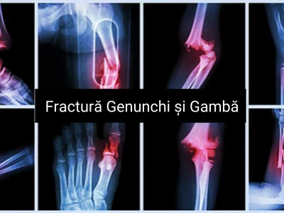 fracturi genunchi